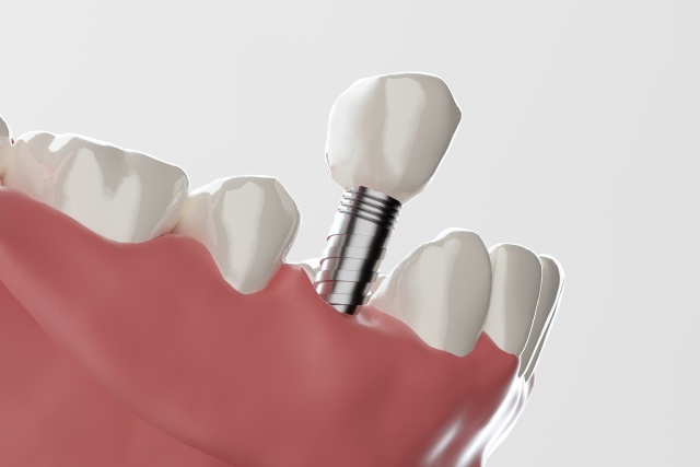 徳島で矯正歯科を検討したい！口コミでも評価が高いおすすめのインプラントとは？